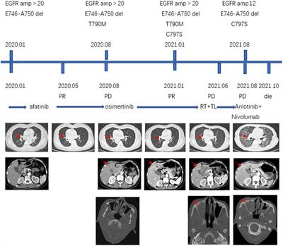 Sinus metastasis of lung adenocarcinoma: a case report